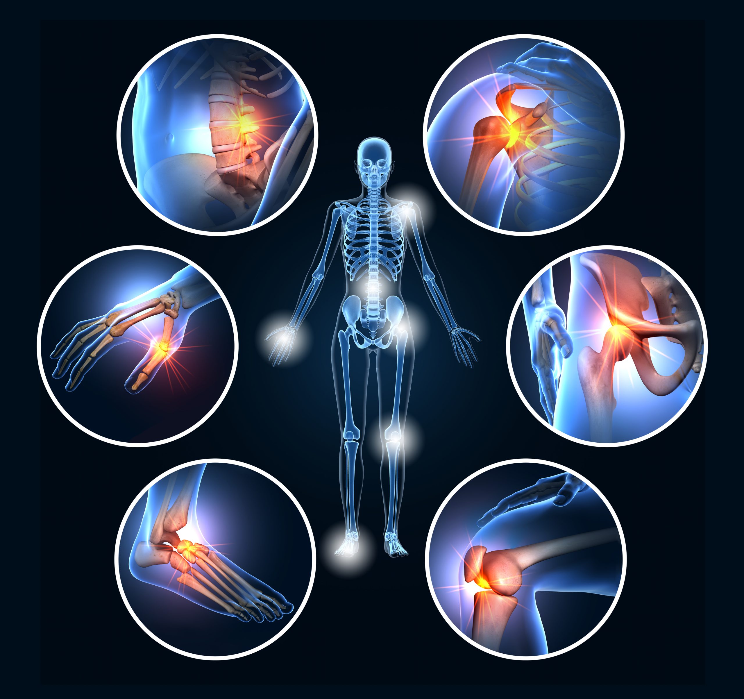 Painful joints, rheumatoid arthritis, osteoarthritis, 3D illustr